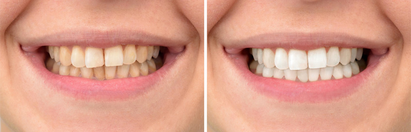 whiten teeth sammamish
